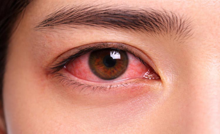 感染症になった眼のイメージ